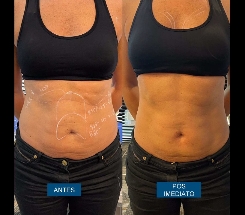 Antes e depois — abdômen pós imediato
