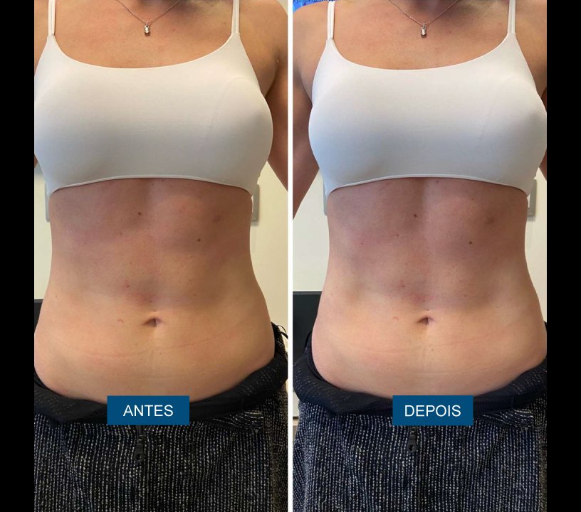 Antes e depois — abdômen
