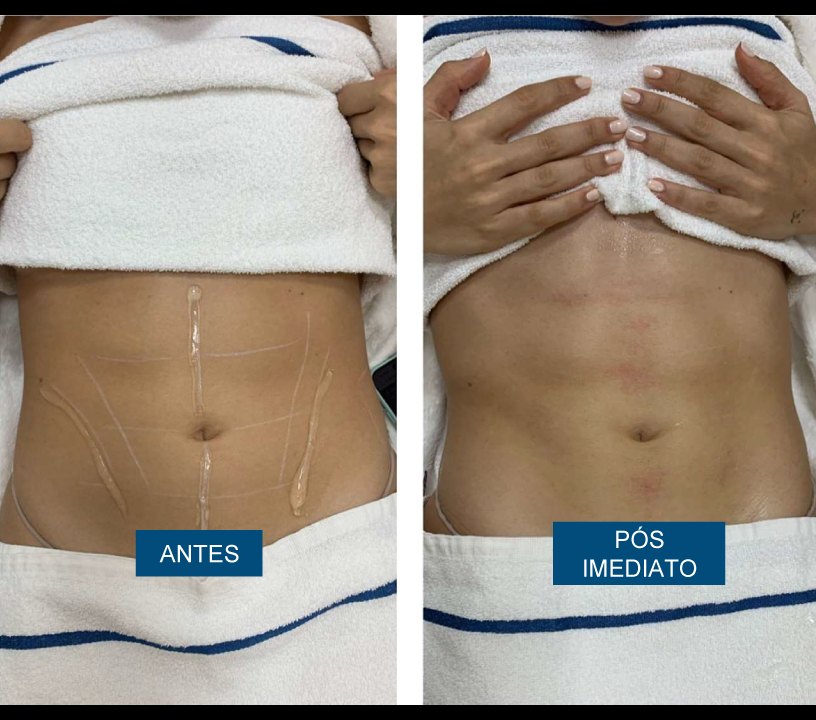 Antes e depois — flacidez abdominal