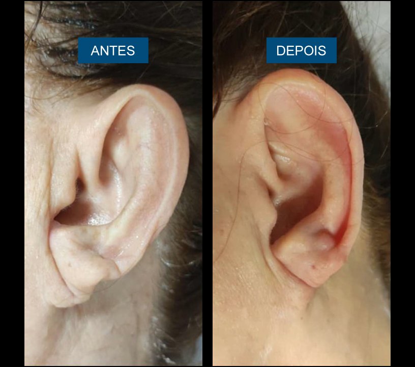 Antes e depois — região da orelha