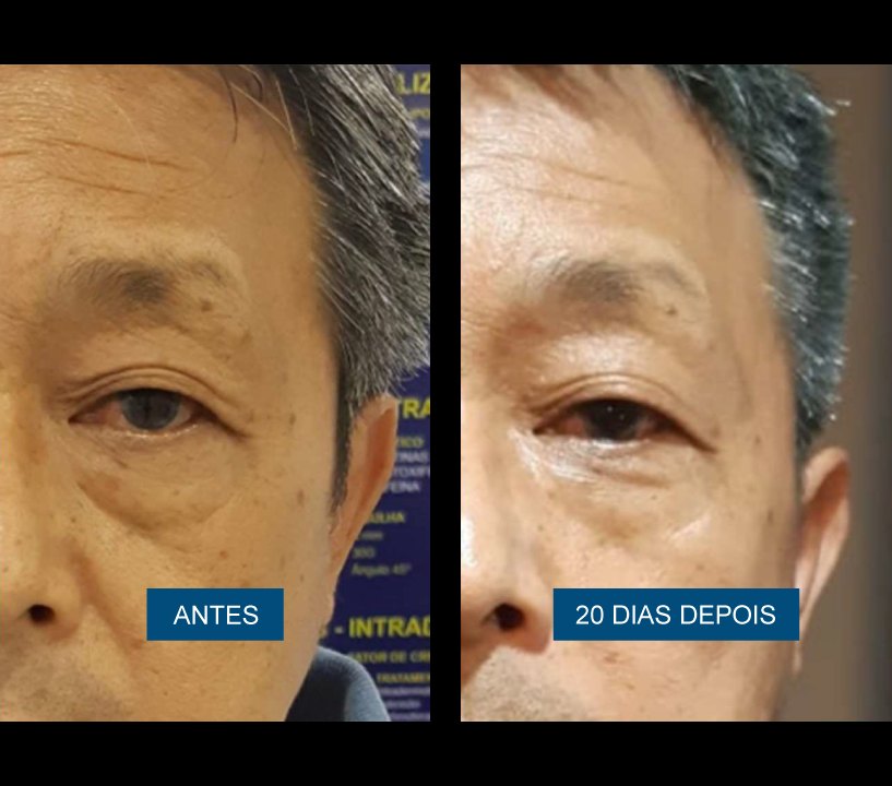 Antes e depois — região dos olhos 20 dias