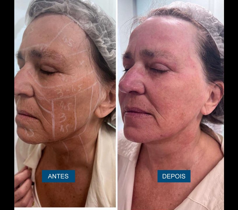 Antes e depois — rejuvenescimento facial