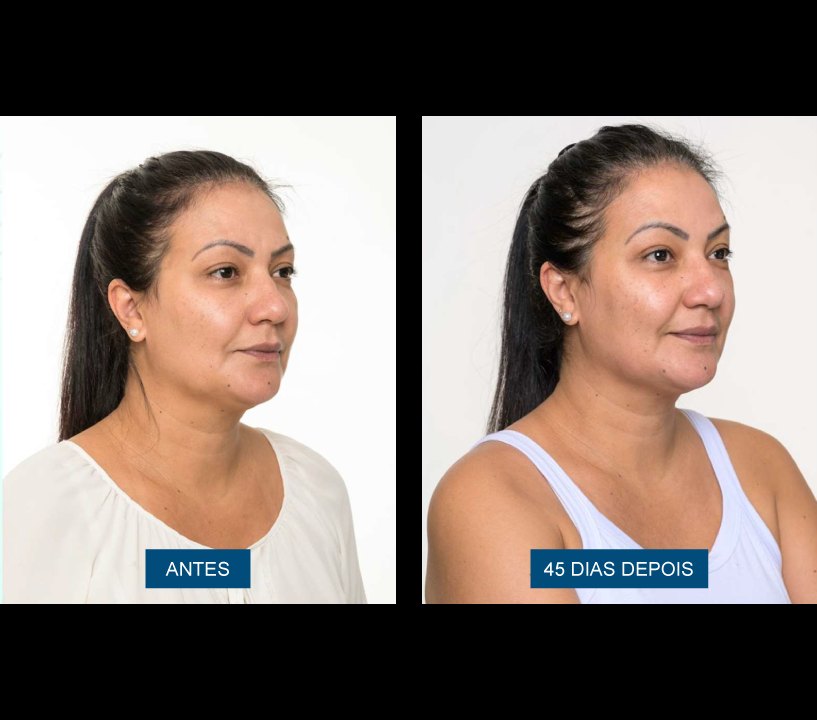Antes e depois — contorno facial 45 dias