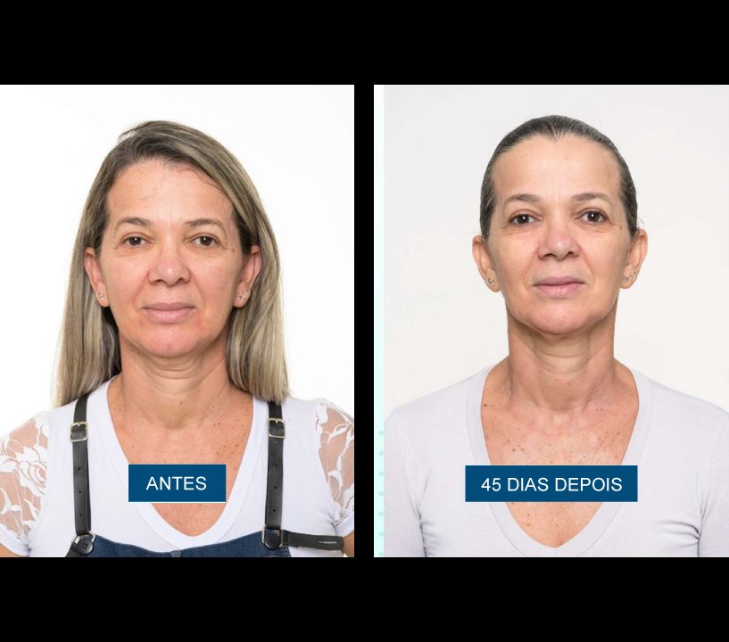 Antes e depois — lifting facial 45 dias